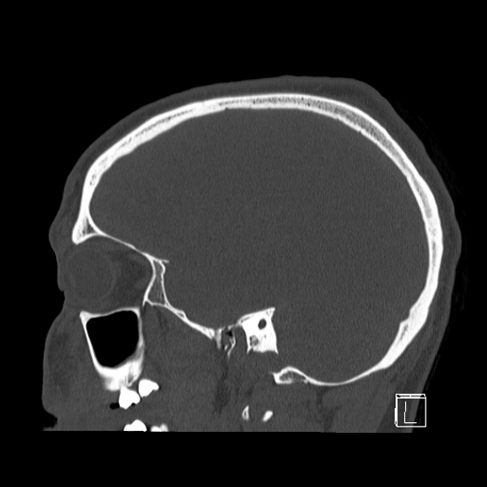 Bilateral occipital condyle fracture (type 2) (Radiopaedia 87675-104089 Sagittal bone window 83).jpg