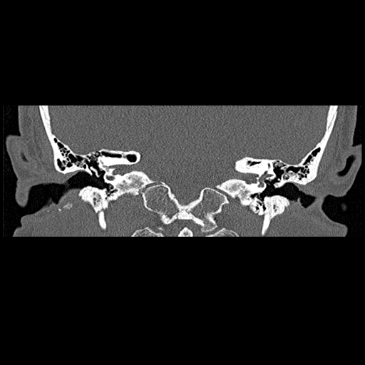 File:Bilateral ossifications of the external auditory canal (Radiopaedia 15233-15076 Coronal bone window 12).jpg