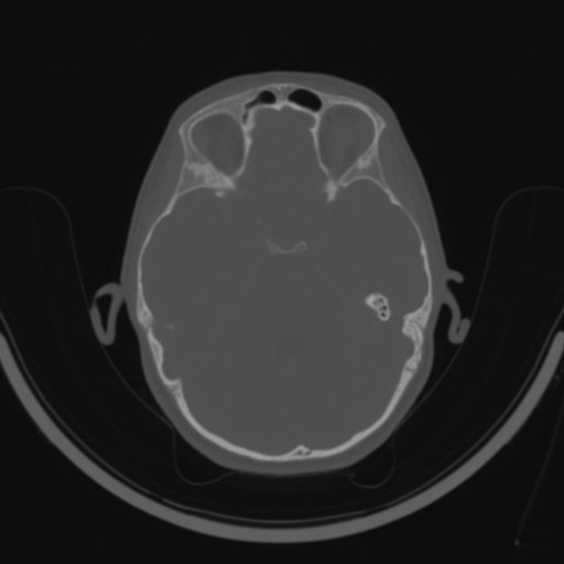 Bilateral otosclerosis (Radiopaedia 57237-64157 C 70).jpg