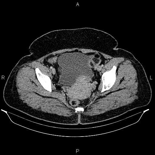 Bilateral ovarian dermoid cysts (Radiopaedia 85785-101603 A 96).jpg