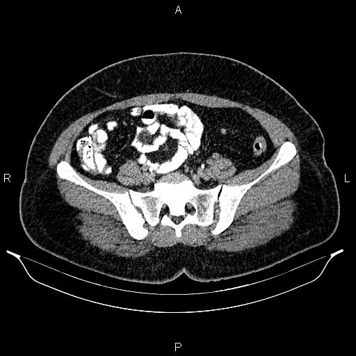 Bilateral ovarian dermoid cysts (Radiopaedia 85785-101603 Axial C+ delayed 59).jpg