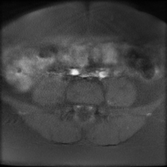 File:Bilateral ovarian fibrothecomas - adolescent (Radiopaedia 86604-102707 Axial T1 fat sat 1).jpg