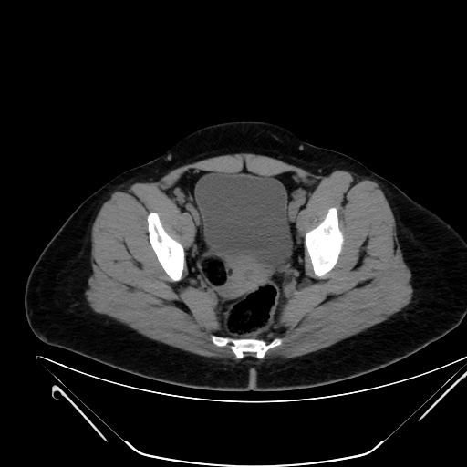Bilateral ovarian mature cystic teratomas (Radiopaedia 79373-92457 Axial non-contrast 70).jpg