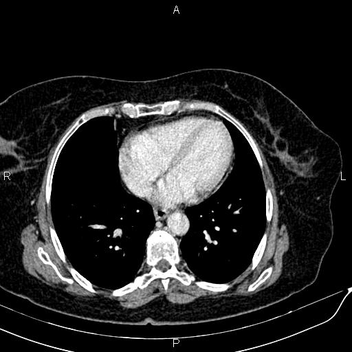 Bilateral ovarian serous cystadenocarcinoma (Radiopaedia 86062-101989 B 8).jpg