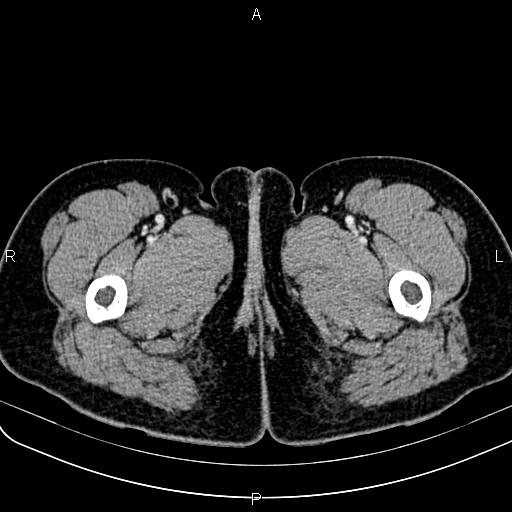 Bilateral ovarian teratoma (Radiopaedia 83131-97503 Axial With contrast 99).jpg