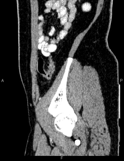 Bilateral ovarian teratoma (Radiopaedia 83131-97503 D 91).jpg