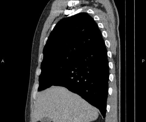 Bilateral pulmonary AVM (Radiopaedia 83134-97505 D 37).jpg