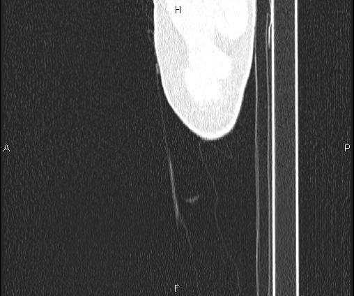 Bilateral pulmonary AVM (Radiopaedia 83134-97505 Sagittal lung window 120).jpg