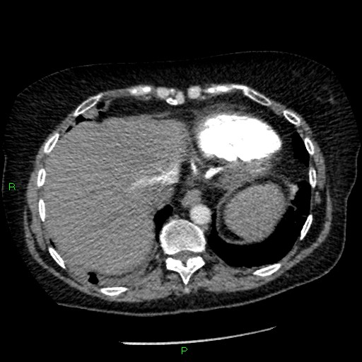 Bilateral pulmonary emboli (Radiopaedia 32700-33669 Axial C+ CTPA 91).jpg