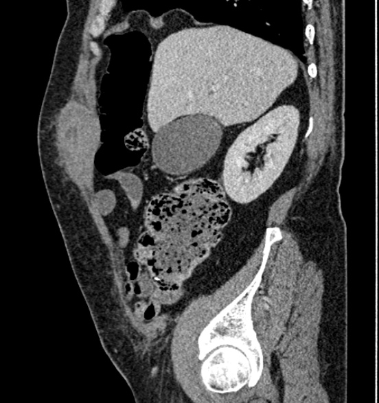 Bilateral rectus sheath hematomas (Radiopaedia 50778-56252 B 23).jpg