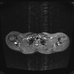 File:Bilateral spinoglenoid notch ganglion cysts (Radiopaedia 29577-30082 E 7).jpg