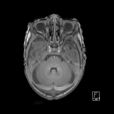 Bilateral subdural hemorrhage and parietal skull fracture (Radiopaedia 26058-26190 Axial T1 14).png