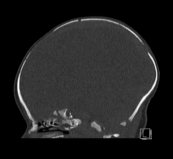 Bilateral subdural hemorrhage and parietal skull fracture (Radiopaedia 26058-26192 Sagittal bone window 55).png