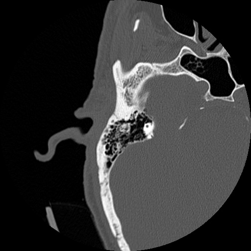 File:Bilateral temporal bone fractures (Radiopaedia 29482-29970 Axial non-contrast 40).jpg