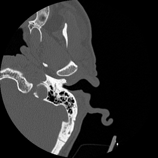 Bilateral temporal bone fractures (Radiopaedia 29482-29970 D 35).jpg