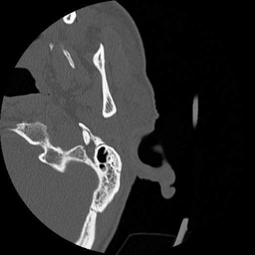 Bilateral temporal bone fractures (Radiopaedia 29482-29970 D 5).jpg
