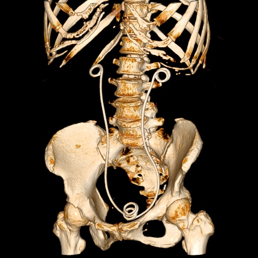 File:Bilateral ureteric stents (Radiopaedia 48795-53825 Oblique VRT 1).jpg