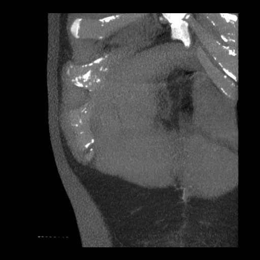 File:Bile leak from liver traumatic laceration (Radiopaedia 63463-72077 Coronal Biliscopin 4).jpg