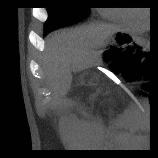 File:Bile leak from liver traumatic laceration (Radiopaedia 63463-72077 Coronal Biliscopin 6).jpg