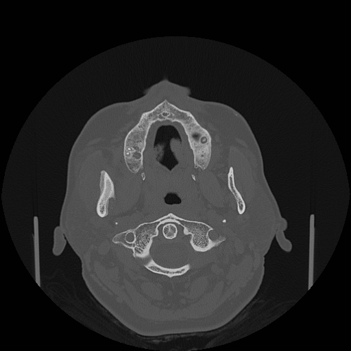 File:Bisphosphonate-related osteonecrosis of the jaw (Radiopaedia 71324-81642 Axial bone window 110).jpg