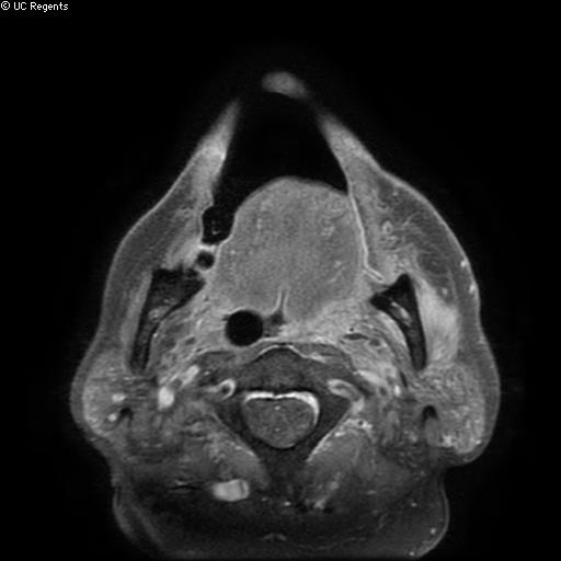 Bisphosphonate-related osteonecrosis of the maxilla (Radiopaedia 51367-57101 Axial T1 C+ fat sat 10).jpg
