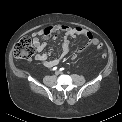 File:Bladder papillary urothelial carcinoma (Radiopaedia 48119-52951 A 34).png