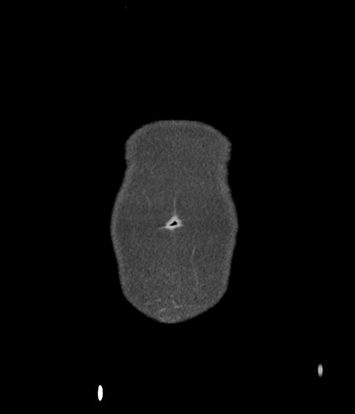 Bladder rupture post renal biopsy (Radiopaedia 30863-31572 Coronal non-contrast 4).jpg