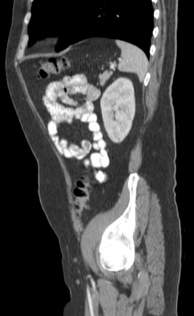 Bleeding duodenal ulcer and adenomyomatosis of gallbladder (Radiopaedia 61834-69861 C 79).jpg