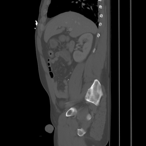 File:Blunt abdominal trauma with solid organ and musculoskelatal injury with active extravasation (Radiopaedia 68364-77895 Sagittal bone window 31).jpg