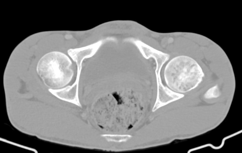 Blunt injury to the small bowel (Radiopaedia 74953-85987 Axial Wide 93).jpg