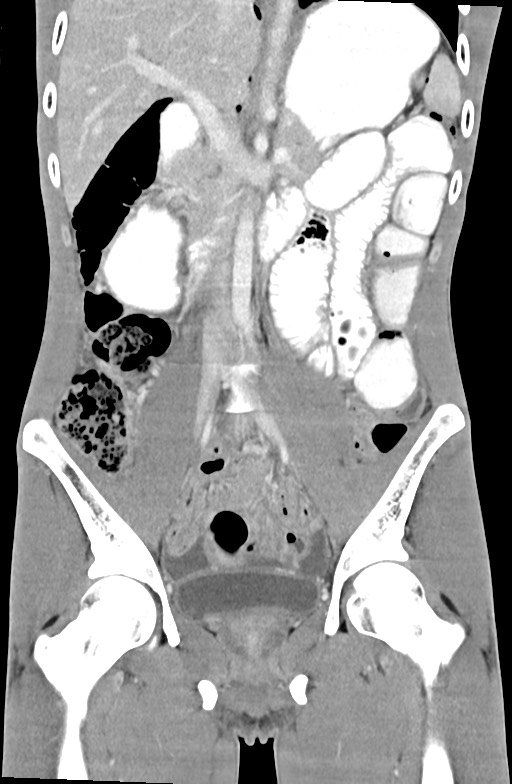 Blunt injury to the small bowel (Radiopaedia 74953-85987 B 48).jpg