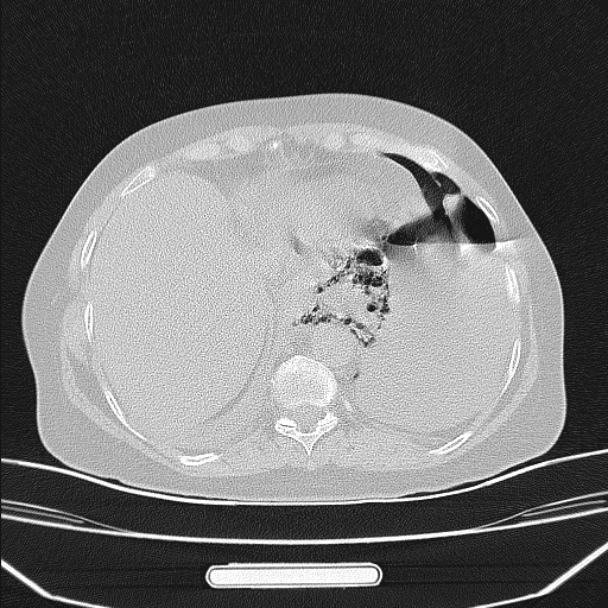 Boerhaave syndrome (Radiopaedia 45644-49799 Axial lung window 93).jpg
