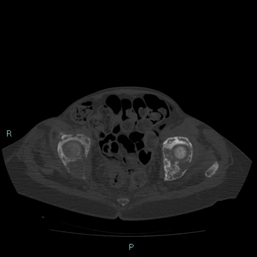 Bone metastases from untreated breast cancer (Radiopaedia 42973-46219 Axial bone window 178).jpg