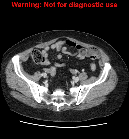File:Bosniak renal cyst - type II (Radiopaedia 23404-23468 D 55).jpg