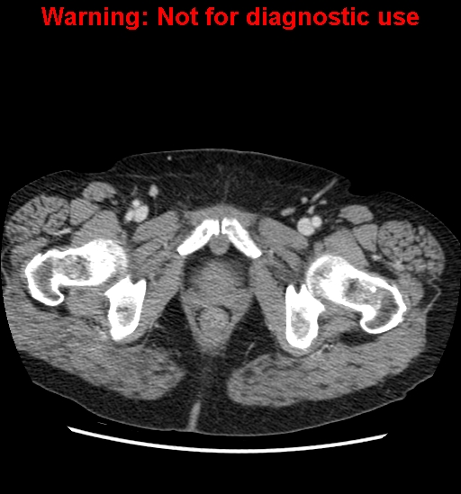 File:Bosniak renal cyst - type II (Radiopaedia 23404-23468 D 74).jpg