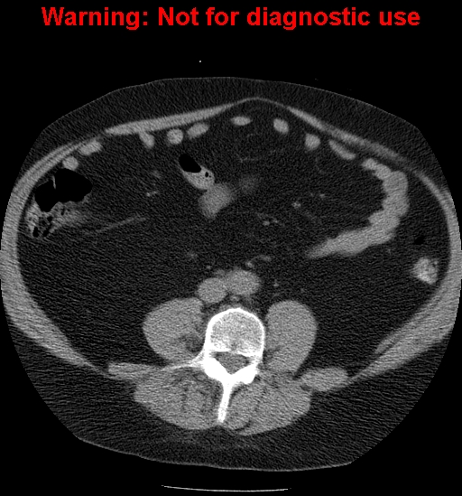 File:Bosniak renal cyst - type IV (Radiopaedia 23402-23466 Axial non-contrast 21).jpg