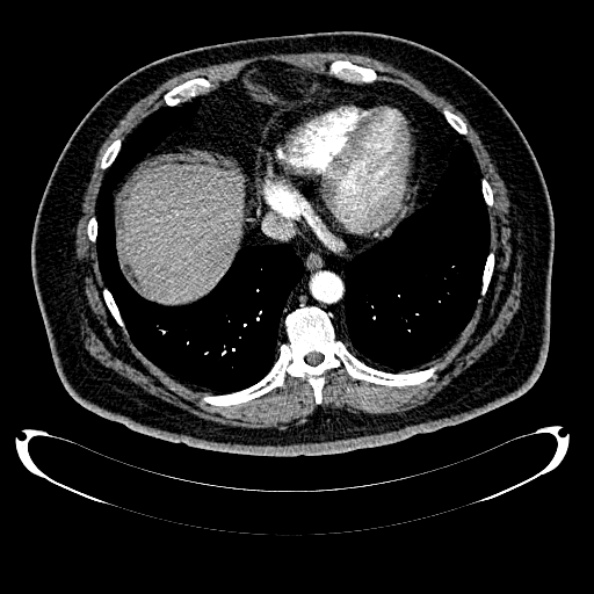 File:Bosniak renal cyst - type IV (Radiopaedia 24244-24518 B 14).jpg