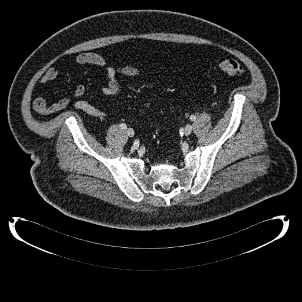 Bosniak renal cyst - type IV (Radiopaedia 24244-24518 C 310).jpg