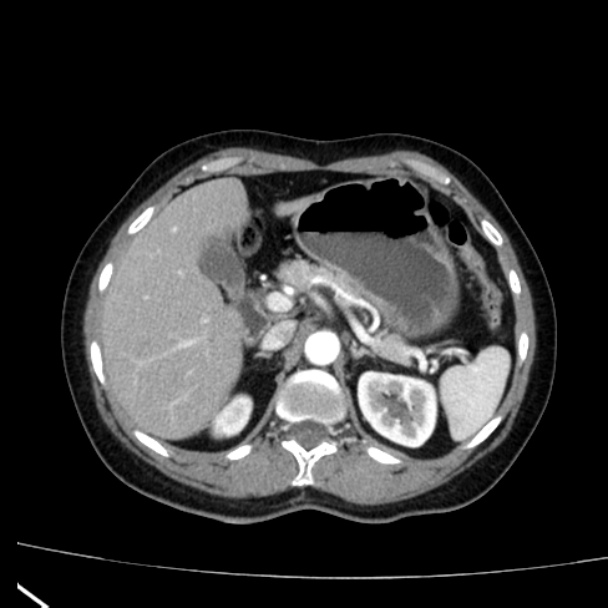 Bosniak renal cyst - type I (Radiopaedia 27479-27675 renal cortical phase 21).jpg