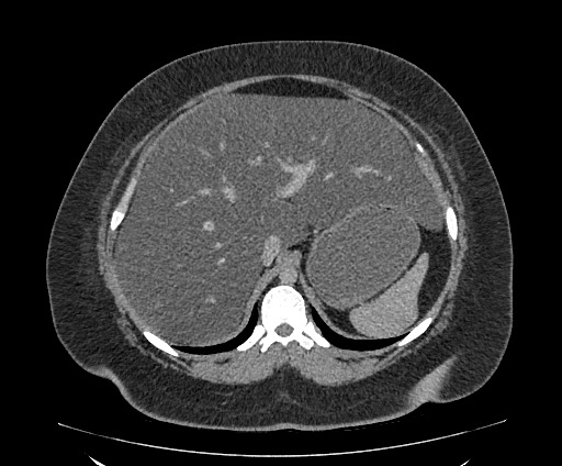 Bowel and splenic infarcts in acute lymphocytic leukemia (Radiopaedia 61055-68913 A 37).jpg
