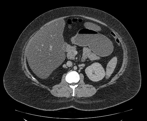 Bowel and splenic infarcts in acute lymphocytic leukemia (Radiopaedia 61055-68913 A 56).jpg