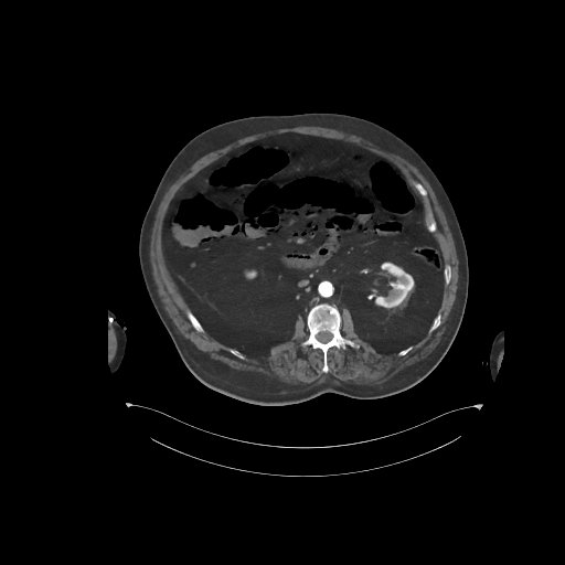 File:Bowel ischemia secondary to SMA occlusion with extensive portomesenteric venous gas (Radiopaedia 54656-60871 A 41).jpg