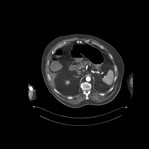 File:Bowel ischemia secondary to SMA occlusion with extensive portomesenteric venous gas (Radiopaedia 54656-60871 A 57).jpg