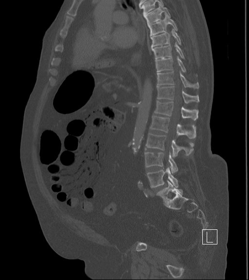 File:Bowel ischemia secondary to SMA occlusion with extensive portomesenteric venous gas (Radiopaedia 54656-60871 Sagittal bone window 50).jpg