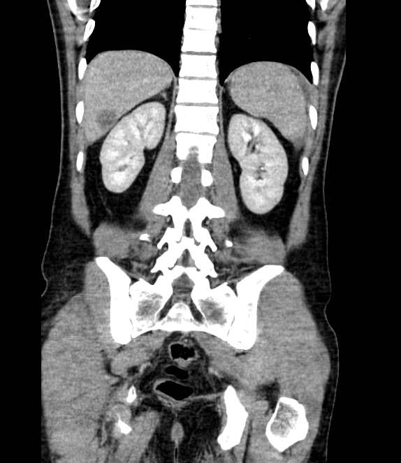 Bowel obstruction from colon carcinoma (Radiopaedia 22995-23028 C 56).jpg