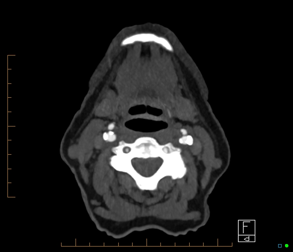 Brachiocephalic trunk stenosis (Radiopaedia 87242-103519 A 93).jpg