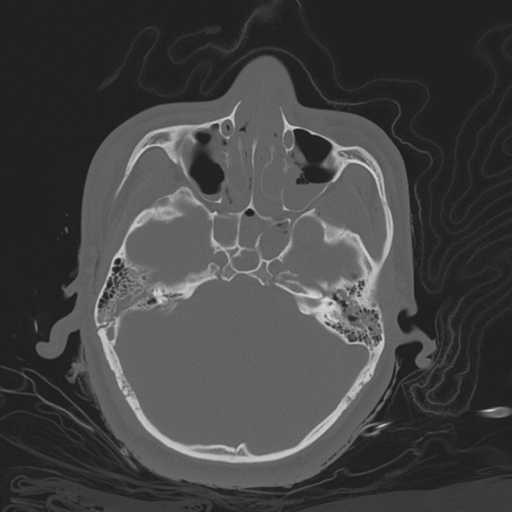 Brain contusions, internal carotid artery dissection and base of skull fracture (Radiopaedia 34089-35339 Axial bone window 57).png