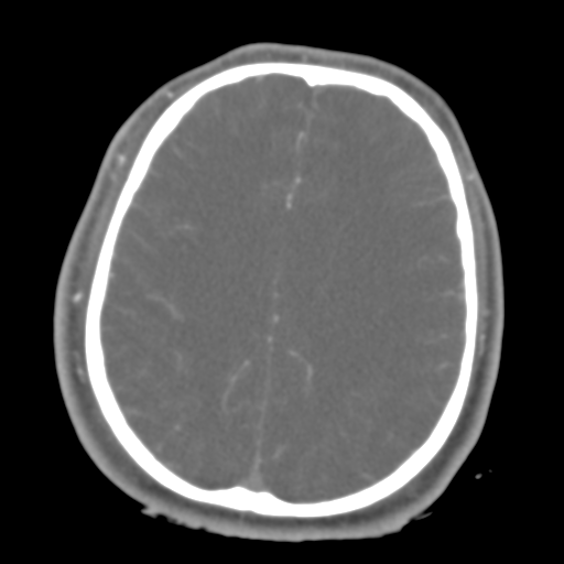 Brain contusions, internal carotid artery dissection and base of skull fracture (Radiopaedia 34089-35339 D 18).png