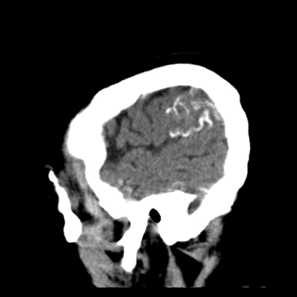 Brain cortical laminar necrosis (Radiopaedia 25822-25971 non-contrast 43).jpg