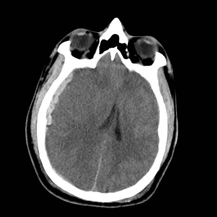 File:Brain death after motor vehicle collision (Radiopaedia 88470-105114 Axial 6).png
